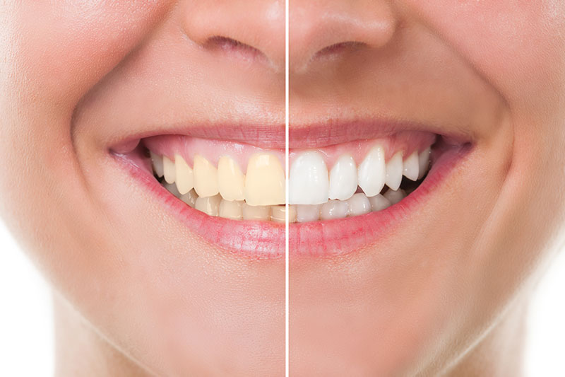 Teeth Whitening - Azusa Dental Clinic, La Puente Dentist