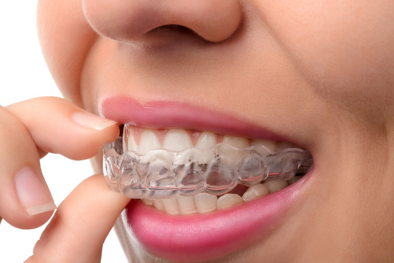 Invisalign - Azusa Dental Clinic, La Puente Dentist